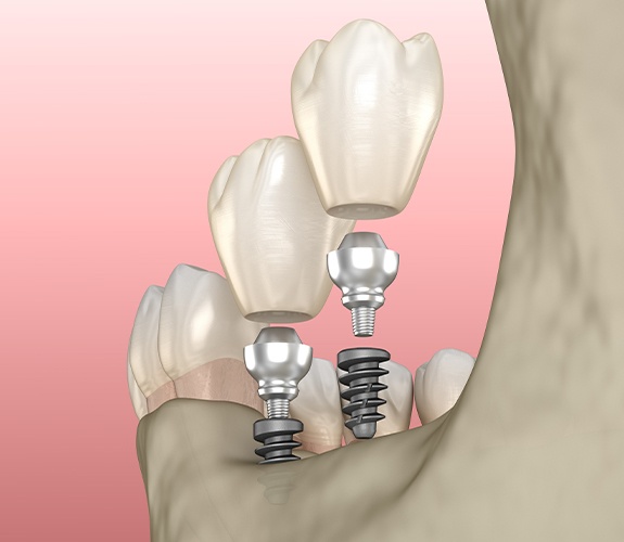Animated dental implant supported dental crown restorations
