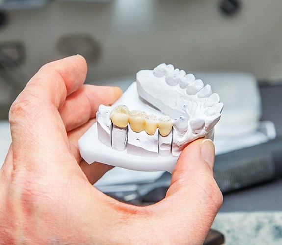 A dental bridge sitting in a dental impression
