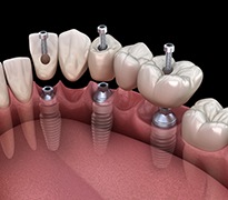 A 3D illustration of an implant bridge being placed