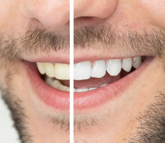 Closeup of smile before and after teeth whitening