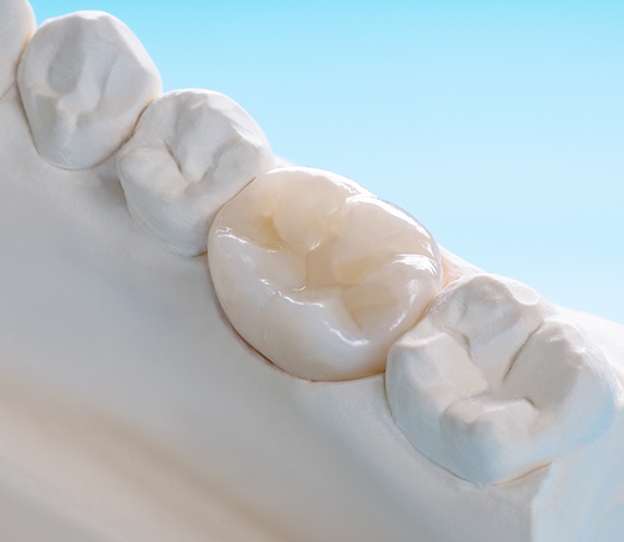 Model smile with dental crown restoration