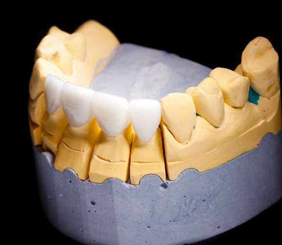 Model smile with fixed bridge restoration