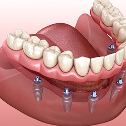 Implant dentures in Marion