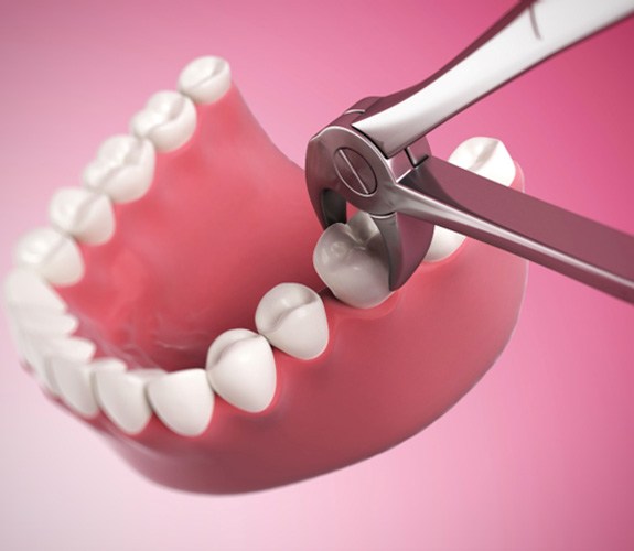3D illustration of tooth extraction 