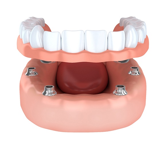Illustration of implant dentures in Marion, IN being placed on lower arch