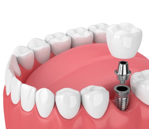 dental implant 3D graphic