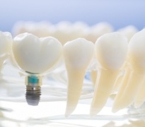 Model smile with dental implant supported dental crown