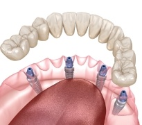 Animated all on four dental implant supported denture placement