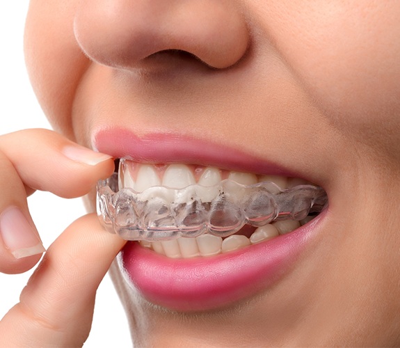 Patient placing an Invisalign tray