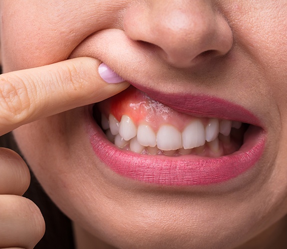 Closeup of patient with inflamed soft tissue indicating potential oral cancer