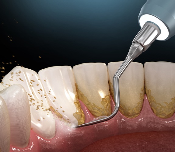 Animated smile during teeth cleaning