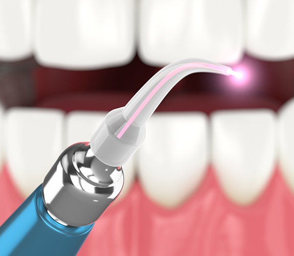 Laser periodontal therapy tools