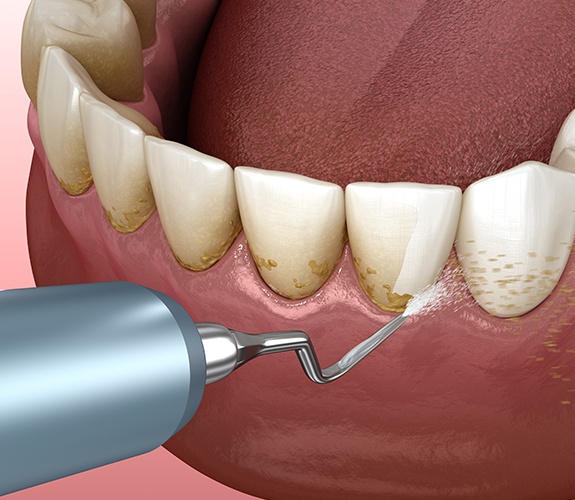 Animated smile during gum disease treatment