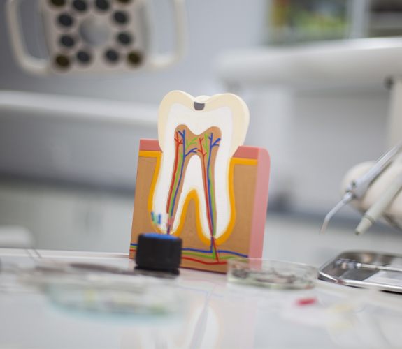 Model of the inside of the tooth before root canal therapy