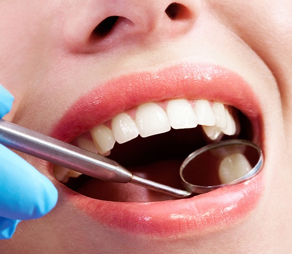 Dentist examining patient's smile after tooth colored filling restoration