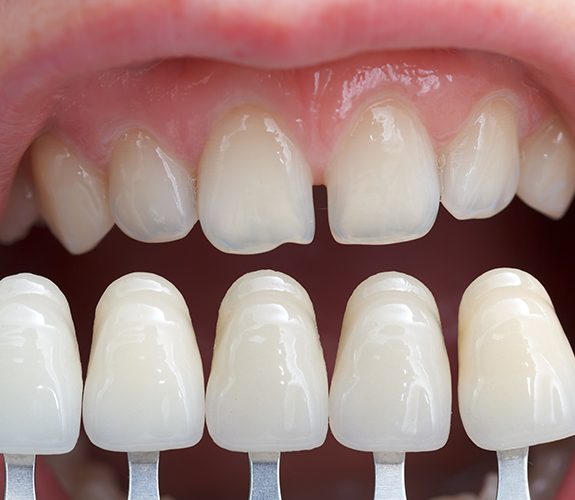 Closeup of smile compared with dental veneer options
