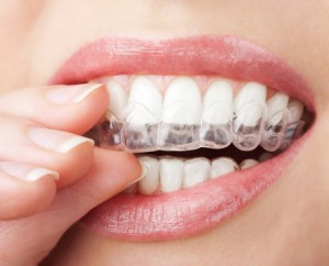 Are you living with misaligned teeth? Learn more about the benefits of Invisalign in Marion.