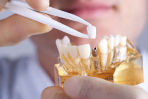 You can replace lost teeth with dental implants in Marion. 