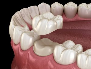 3D illustration of dental crown 