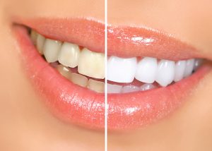 Before and after comparison of teeth whitening